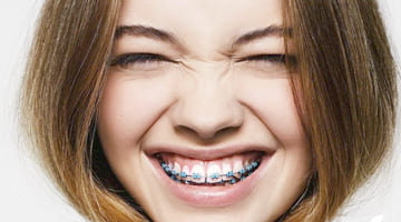 ОРТОДОНТИЯ<br> (брекеты)